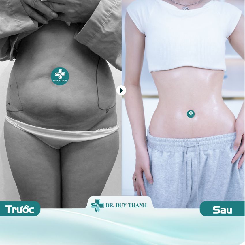 [Hút Mỡ] Dr Duy Thanh Tái Tạo Body Đẹp Không Tì Vết