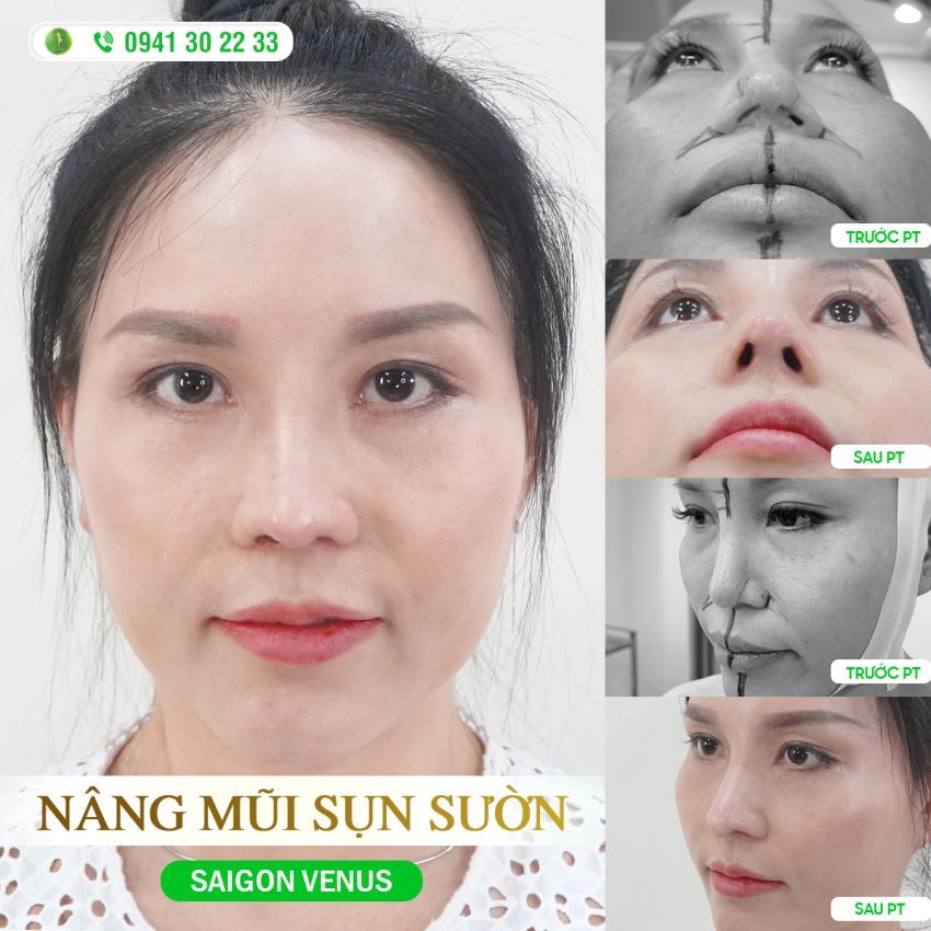 FEEDBACK TÁI XUẤT MŨI BIẾN DẠNG CHO KHÁCH HÀNG CẨM HOA