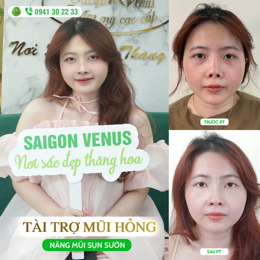 KẾT QUẢ HÀNH TRÌNH GIẢI CỨU MŨI BỊ MẤT CỦA THÙY LINH