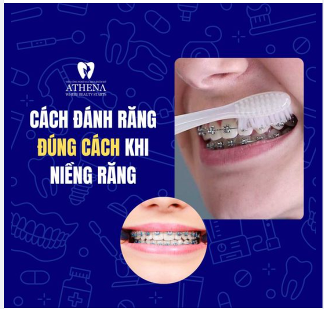 Quy trình chải răng đúng cách khi niềng