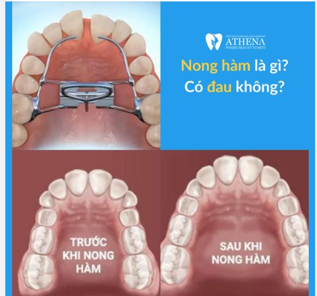 Nong hàm là gì? có đau không?
