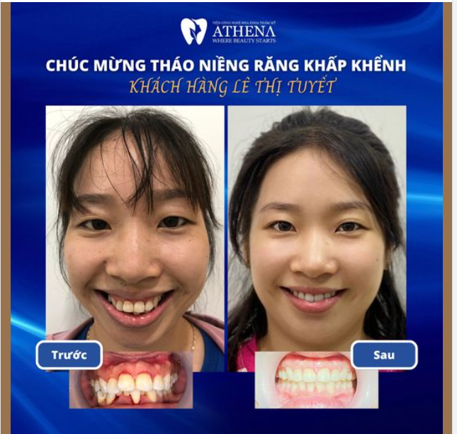 Cải thiện nụ cười với niềng răng  - Đừng để lỡ cơ hội