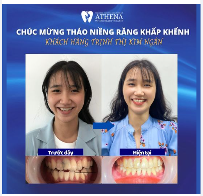 Niềng răng khắc phúc tình trạng khấp khểnh vì một nụ cười bừng sáng thành công 