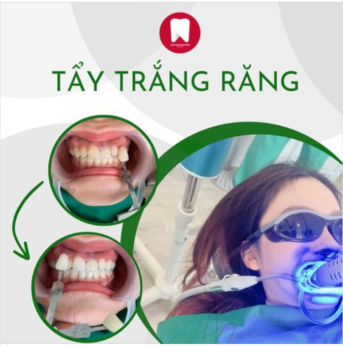 THAY MÀU ÁO CHO HÀM RĂNG BẰNG PHƯƠNG PHÁP TẨY TRẮNG RĂNG TẠI NHA KHOA NGỌC BÍCH
