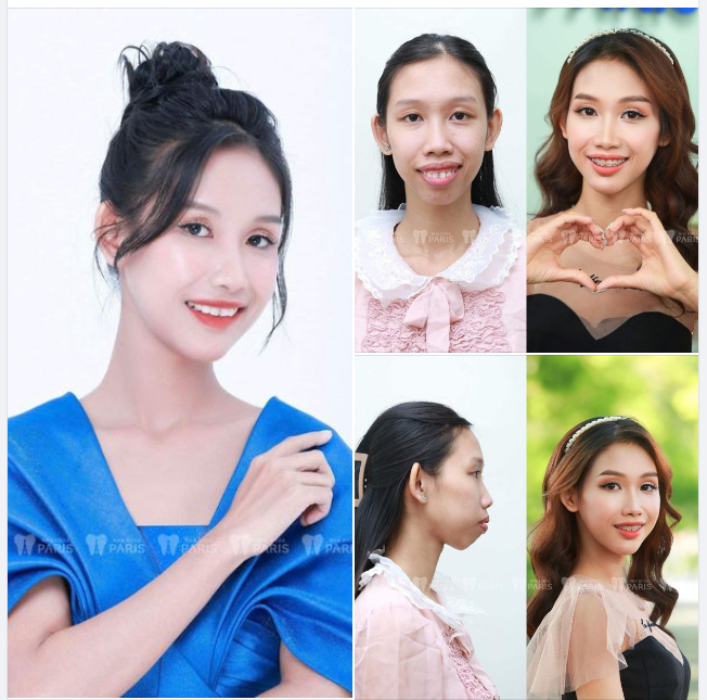 THANH THƯƠNG VÀ HÀNH TRÌNH THAY ĐỔI DIỆN MẠO NHỜ NIỀNG RĂNG