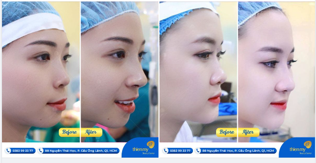 Khách hàng của PKCK Thiện Mỹ tự tin khoe góc nghiêng đẹp không tì vết sau nâng mũi đây ạ