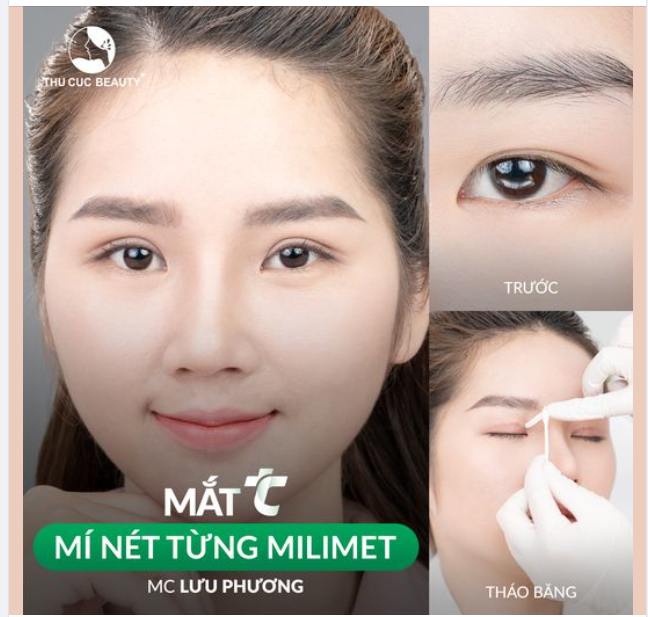 Say 'bye' mí lót vì Thu Cúc đã có thể giúp bạn sở hữu mí mắt cân đều, sắc nét