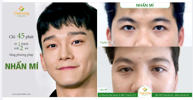 NHẤN MÍ - PHƯƠNG PHÁP NHANH GỌN CHO ĐÔI MẮT CUỐN HÚT HƠN