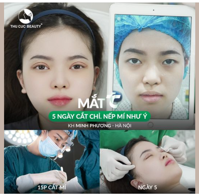 Chiêm ngưỡng nếp mí sau 5 ngày cắt chỉ của khách hàng