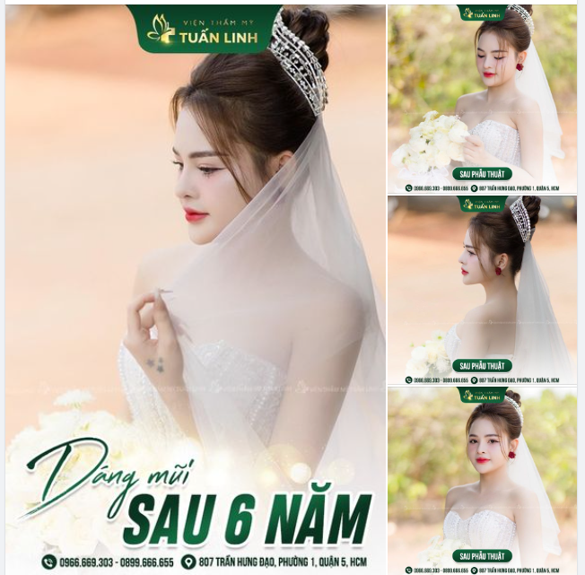 DÁNG MŨI ĐẸP TUYỆT ĐỈNH SAU 6 NĂM NÂNG TẠI TUẤN LINH: