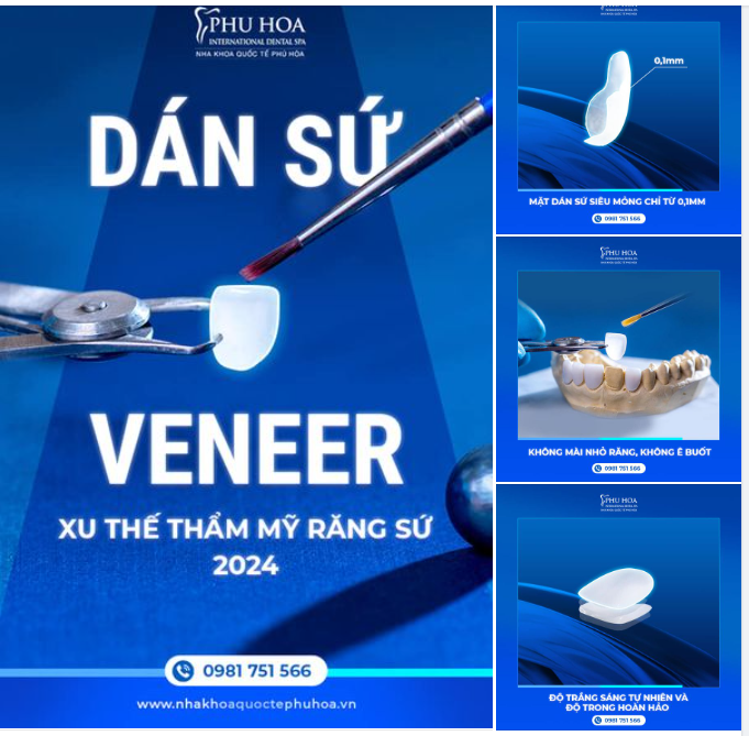 DÁN SỨ VENEER – XU THẾ THẨM MỸ RĂNG SỨ 2024