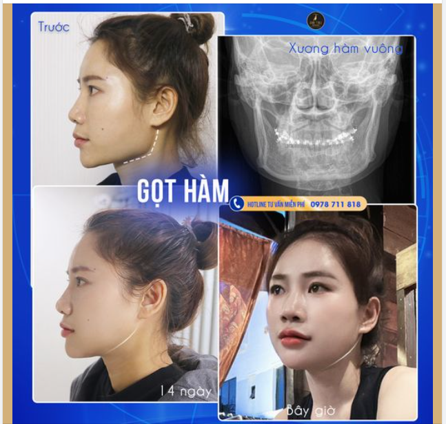 Góc nghiêng với đường viền hàm mượt mà
