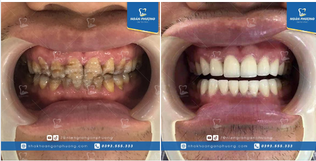 Ở tuổi trung niên, răng mòn mẻ, sâu hỏng là điều không tránh khỏi. Anh khách còn bị nhiễm màu tetra nên “nói chuyện anh còn ngại chứ đừng bảo cười”