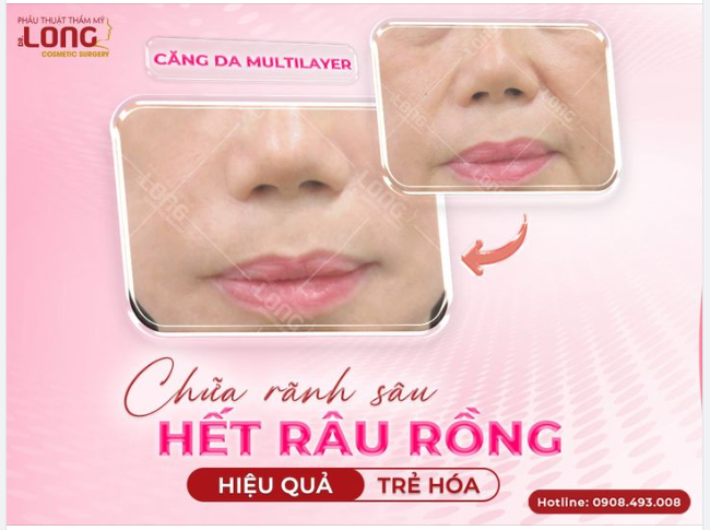 CHỮA RÃNH SÂU - HẾT RÂU RỒNG