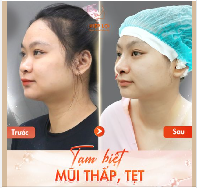 Từng buồn vì dáng mũi thấp khiến gương mặt kém duyên, bạn gái quyết định thực hiện nâng mũi cấu trúc để thay đổi nhan sắc.