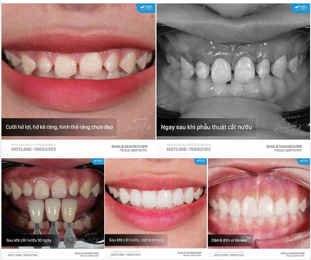 CHỮA CƯỜI HỞ LỢI GIẢI ĐÁP 7 CÂU HỎI PHỔ BIẾN