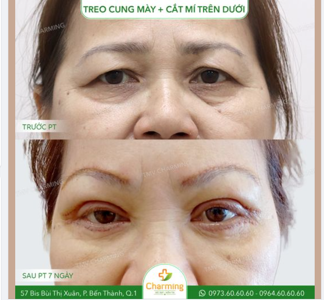 Mí sụp, da chùng, mỡ thừa quanh mắt nhiều thì phải làm sao? Thì treo cung mày kết hợp cắt mí trên dưới như cô khách của Charming đây chứ làm sao nữa?
