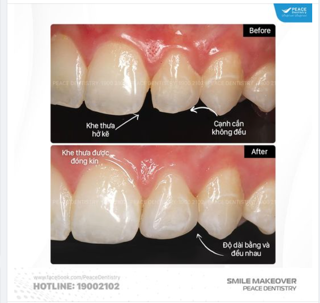 VENEER ĐIỀU CHỈNH HÌNH THỂ RĂNG CÂN ĐỐI, HÀI HOÀ VỀ KÍCH THƯỚC VÀ THẨM MỸ TỰ NHIÊN