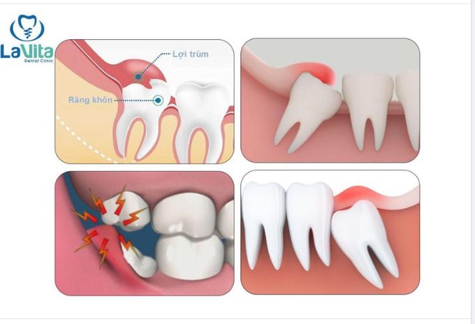 NGUYÊN NHÂN KHIẾN BẠN BỊ ĐAU RĂNG KHÔN