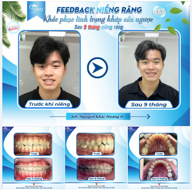 KHẮC PHỤC TÌNH TRẠNG KHỚP CẮN NGƯỢC SAU 9 THÁNG NIỀNG RĂNG