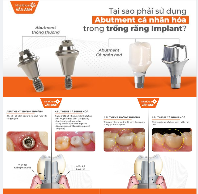 TẠI SAO PHẢI SỬ DỤNG ABUTMENT CÁ NHÂN HÓA TRONG TRỒNG RĂNG IMPLANT?