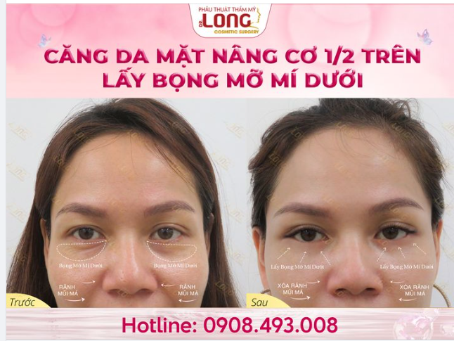 CĂNG DA - giải pháp “đúng” hay “sai” cho làn da LÃO HÓA