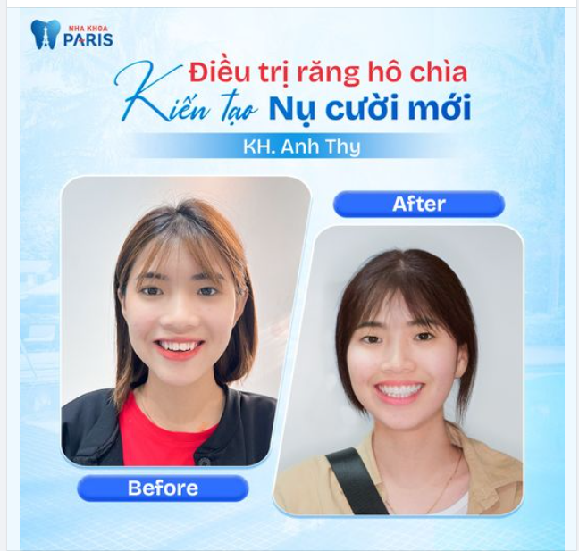 CHÚC MỪNG KH. ANH THY THÁO NIỀNG THÀNH CÔNG!