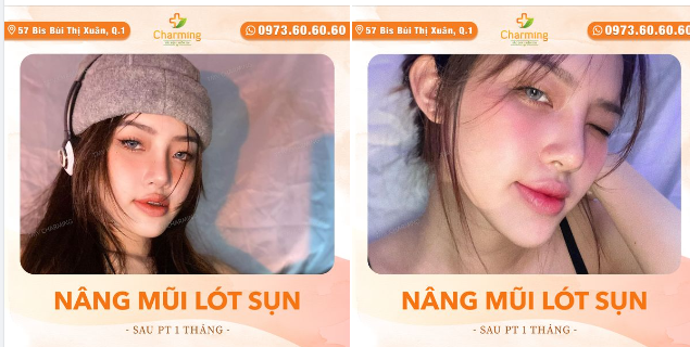 Chỉ mới sau phẫu thuật nâng mũi lót sụn sửa lại thôi mà trông nàng khách đã rất xinh xắn với chiếc mũi mới cân đối, gọn gàng.