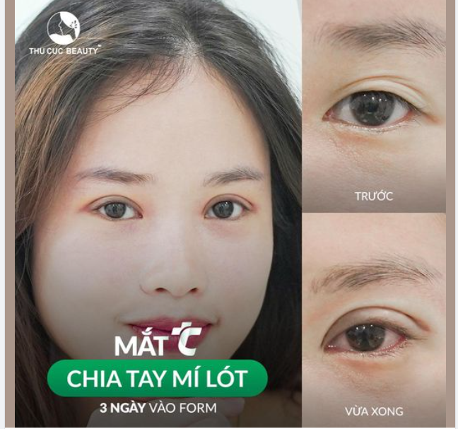 Nếp mÍ của KH Hạnh Linh chỉ sau 15P thực hiện