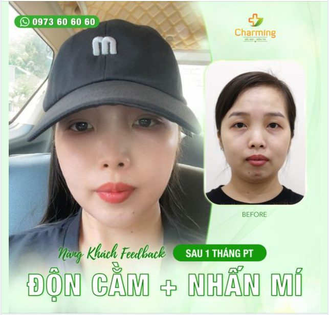Đố mọi người nàng khách của Charming đã thực hiện phẫu thuật gì nào?