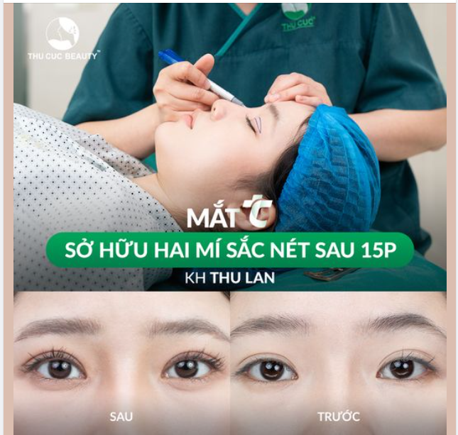 KH Thu Lan sở hữu đôi mắt có hồn hơn sau khi cắt mí tại Thu Cúc