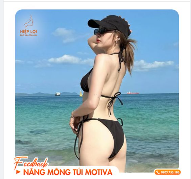 Feedback "nóng bỏng" của khách hàng - Sau 1 tháng nâng mông tại Hiệp Lợi