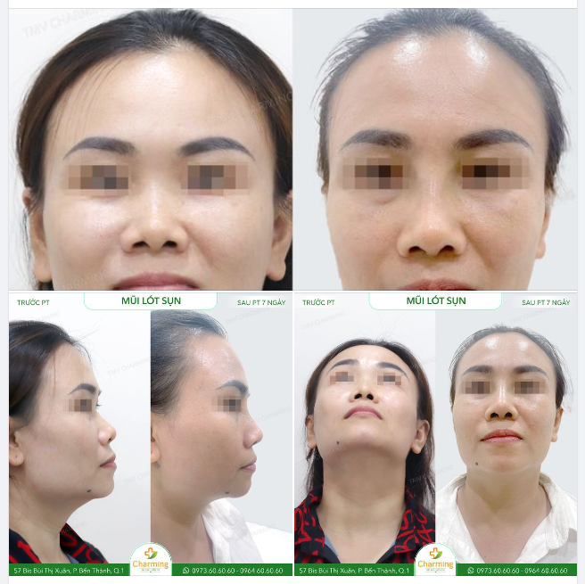Cả gương mặt như được gọn gàng hẳn chỉ bằng phương pháp nâng mũi lót sụn, mọi người có tin được không?!?