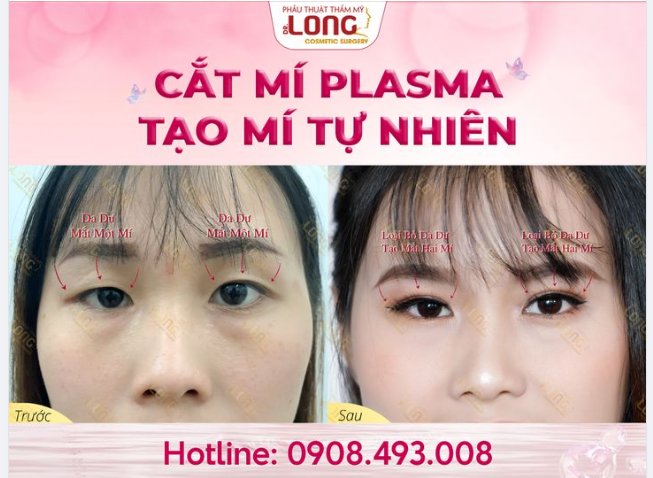 TRẺ ĐẸP HOÀN HẢO Sẹo tàng hình, Nhanh lành thương, Mí mắt lên form đẹp