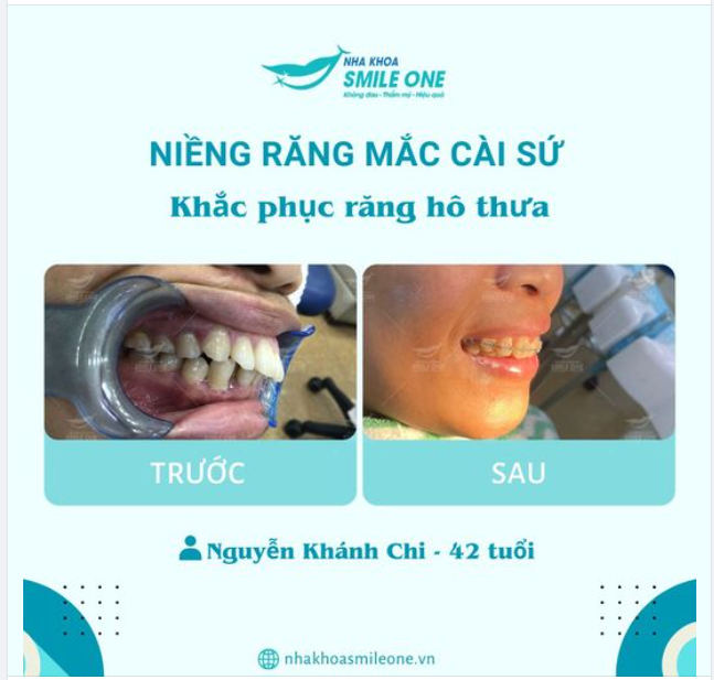 Niềng răng ở người lớn tuổi: Có nên không?