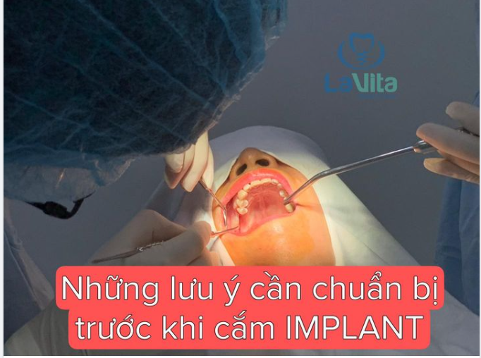 Những lưu ý cần chuẩn bị trước khi Cấy ghép Implant