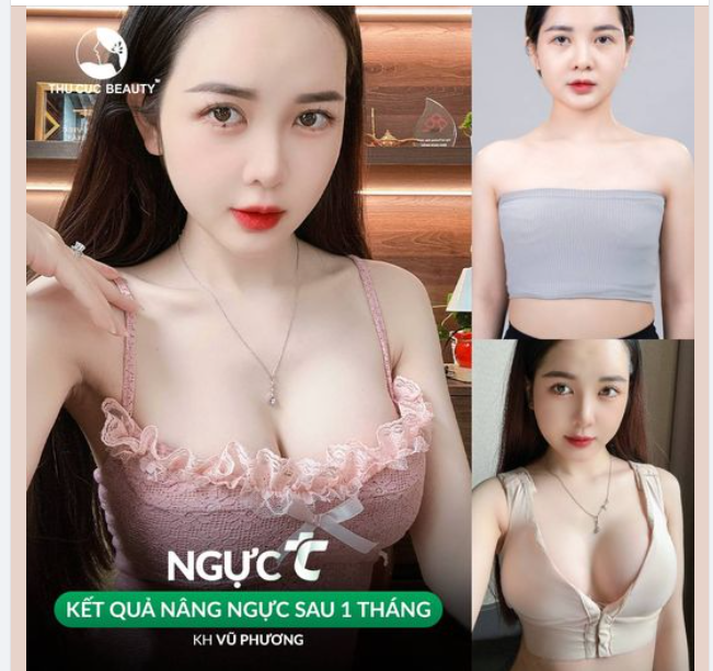 Lựa chọn nâng ngực tại Thu Cúc và kết quả sau 1 tháng