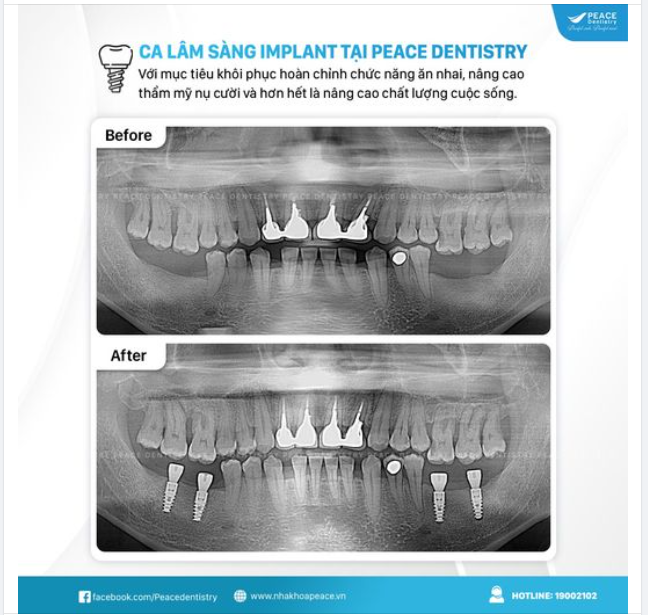 CẤY GHÉP IMPLANT LÀ GIẢI PHÁP TRỒNG RĂNG GIẢ CỐ ĐỊNH ĐEM LẠI HIỆU QUẢ TOÀN DIỆN VỀ THẨM MỸ LẪN CHỨC NĂNG ĂN NHAI