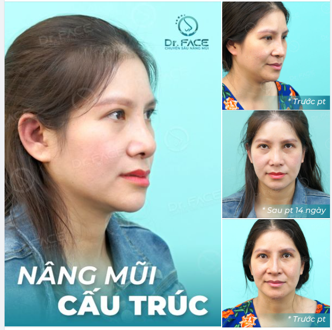 Cả nhà có công nhận là khi chị ấy lựa chọn sửa lại mũi cấu trúc tại DR.FACE, gương mặt trông trẻ và hiền ra hẳn không?