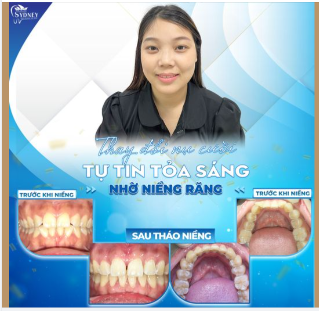 THAY ĐỔI NỤ CƯỜI - TỰ TIN TỎA SÁNG NHỜ NIỀNG RĂNG