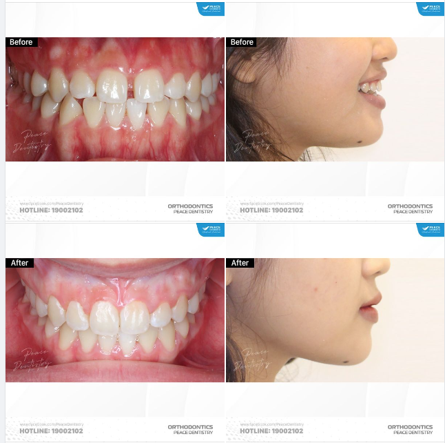 NỤ CƯỜI ĐẸP SAU KHI CHỈNH NHA