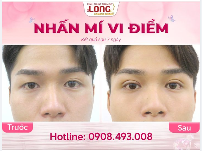 NAM GIỚI NHẤN MÍ TRÊN NỀN MẮT “1 MÍ” VÀ “MÍ LÓT”