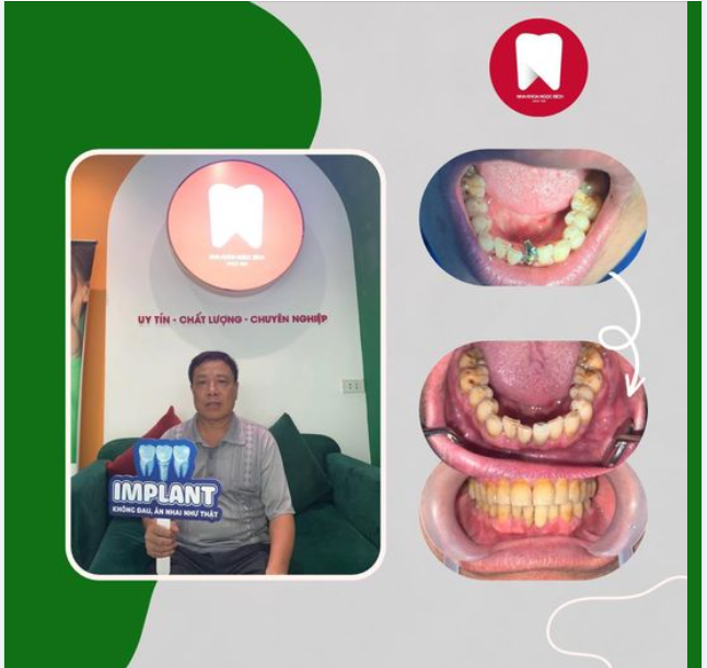 TRỒNG RĂNG IMPLANT TẠI NHA KHOA NGỌC BÍCH