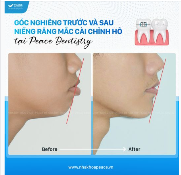 GÓC NGHIÊNG THAY ĐỔI RÕ RỆT SAU KHI NIỀNG RĂNG CHỈNH HÔ TẠI PEACE DENTISTRY