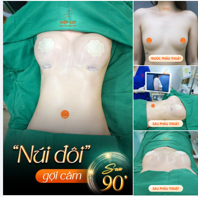 Hình ảnh thực tế sau "nâng cấp" vòng 1 tạI Hiệp Lợi