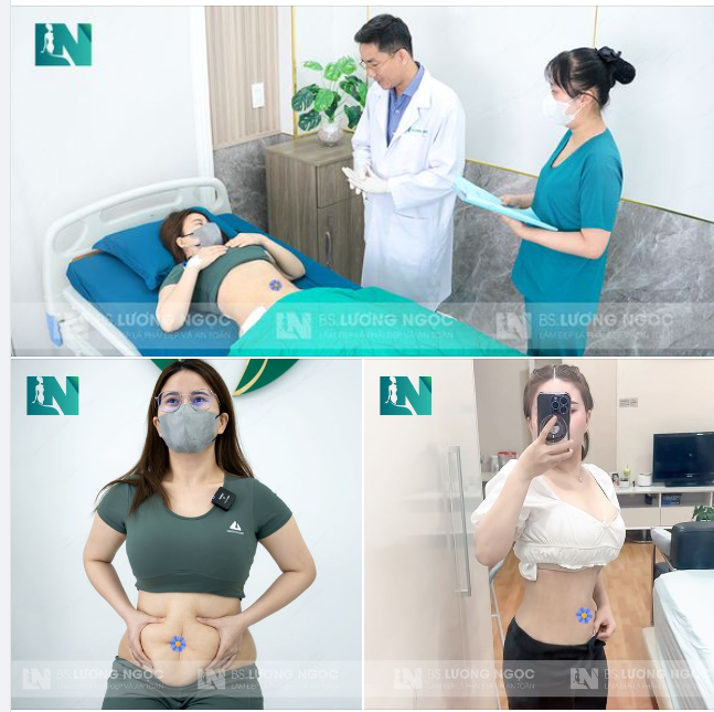 SIẾT EO GIẢM MỠ KHÔNG CẦN CĂNG CẮT DA - GIẢI PHÁP NHANH LẤY LẠI “VÓC DÁNG THON GỌN”