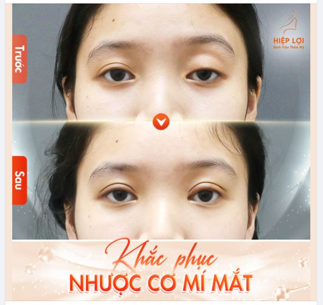 Nhược cơ là tình trạng mí mắt sụp xuống, che khuất một phần hoặc toàn bộ tầm nhìn.