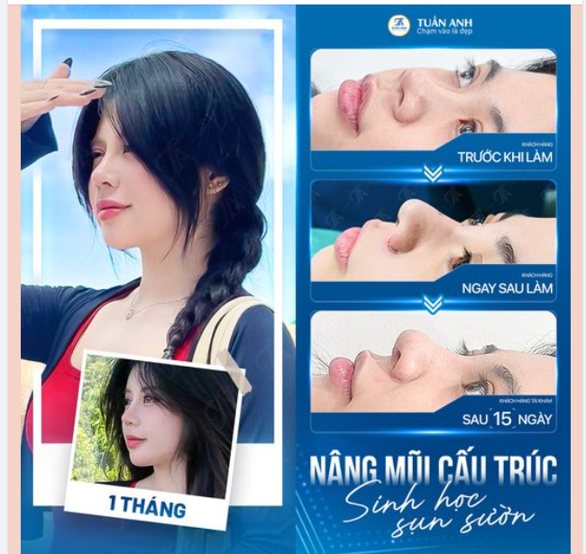 ĐẸP KHÔNG CHỜ ĐỢI AI Chỉ mới 1 tháng nâng mũi thôi…
