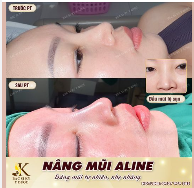SAU NÂNG MŨI ALINE, GƯƠNG MẶT SẼ THAY ĐỔI NHƯ THẾ NÀO?