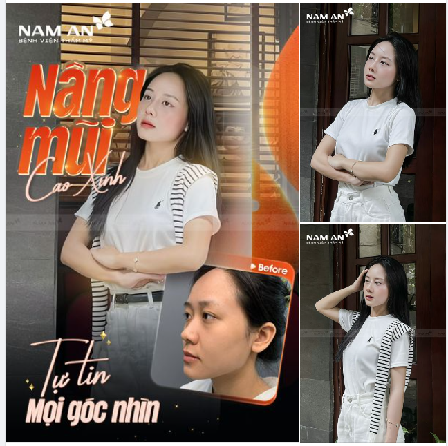NÂNG MŨI CAO XINH - TỰ TIN MỌI GÓC NHÌN